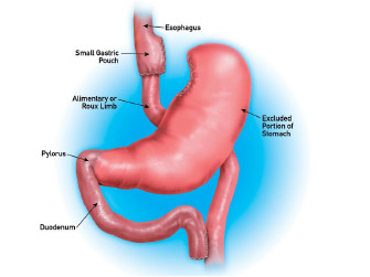 Gastric Bypass Diagram