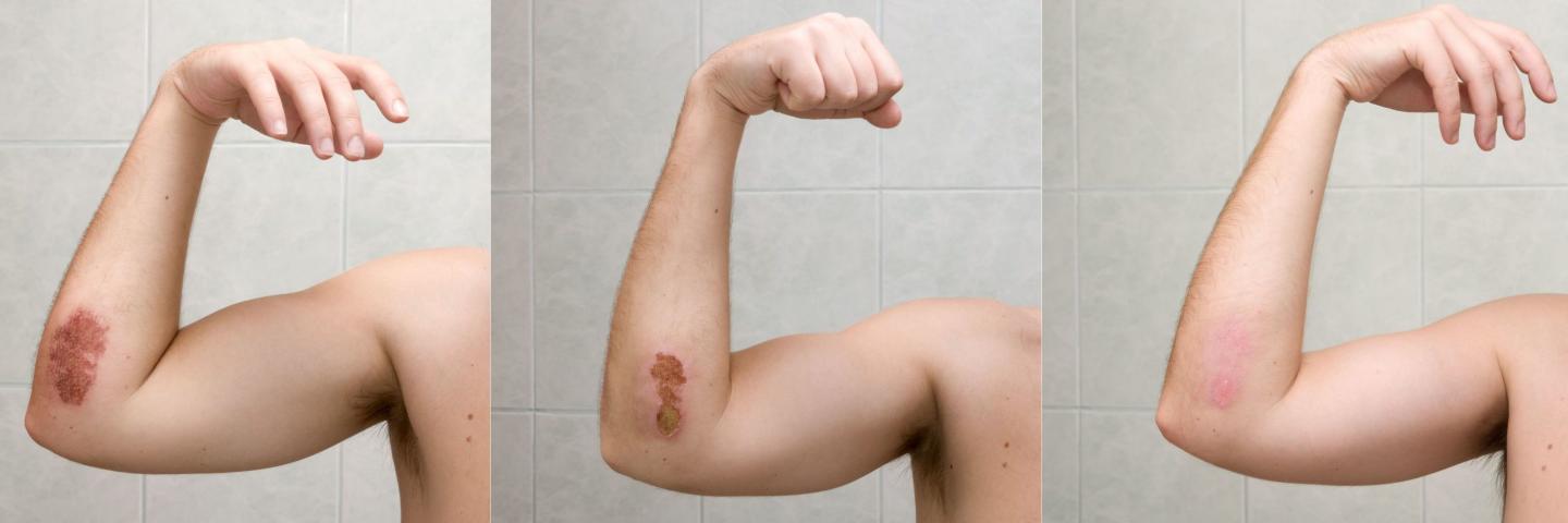 3 phases of a healing wound