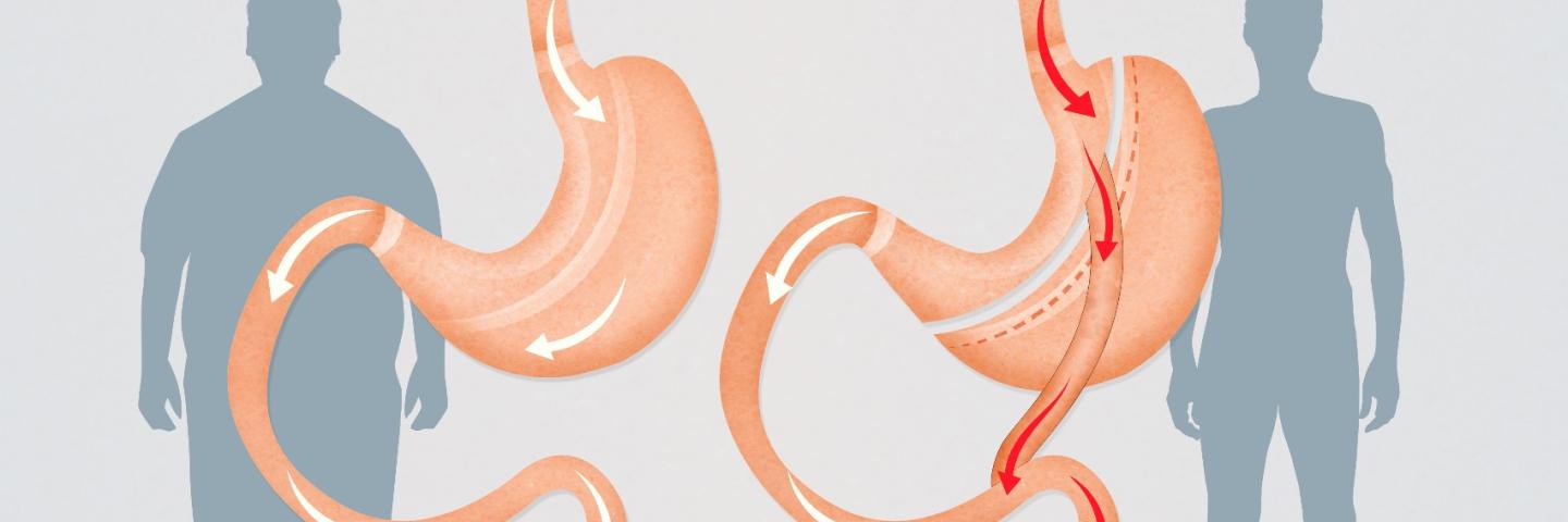Gastric Bypass Image