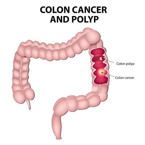 Colon Cancer and polyps diagram