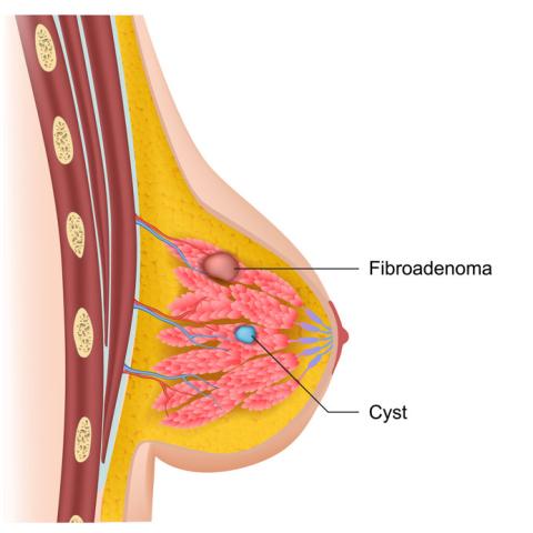 Breast cysts and fibroadenoma medical