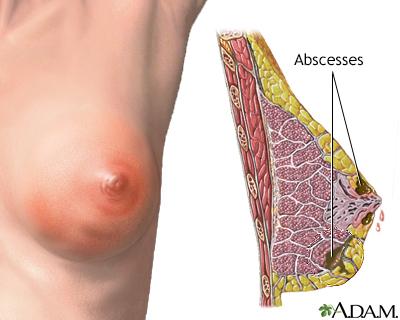 Breast Infection/Abscess