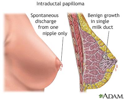 Nipple Discharge