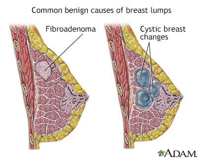 Breast Lumps and Bumps