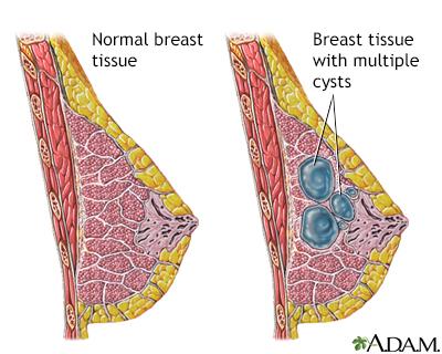 Breast Cysts