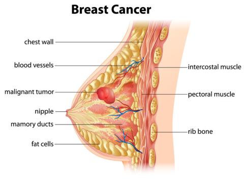 Breast Cancer Diagram