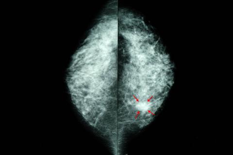 Abnormal Breast Imaging