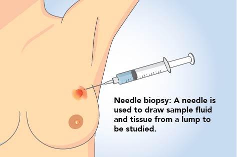 Needle Biopsy  of Breast Lump Explained
