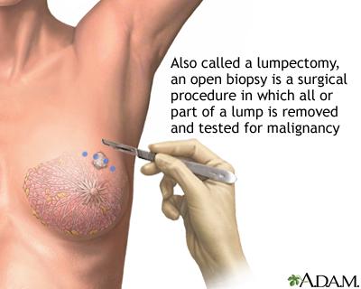 Lumpectomy