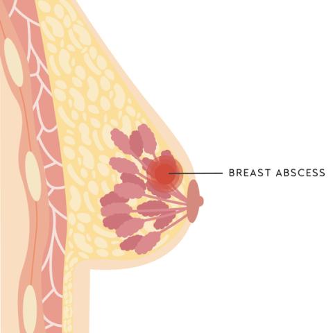 Breast Infection